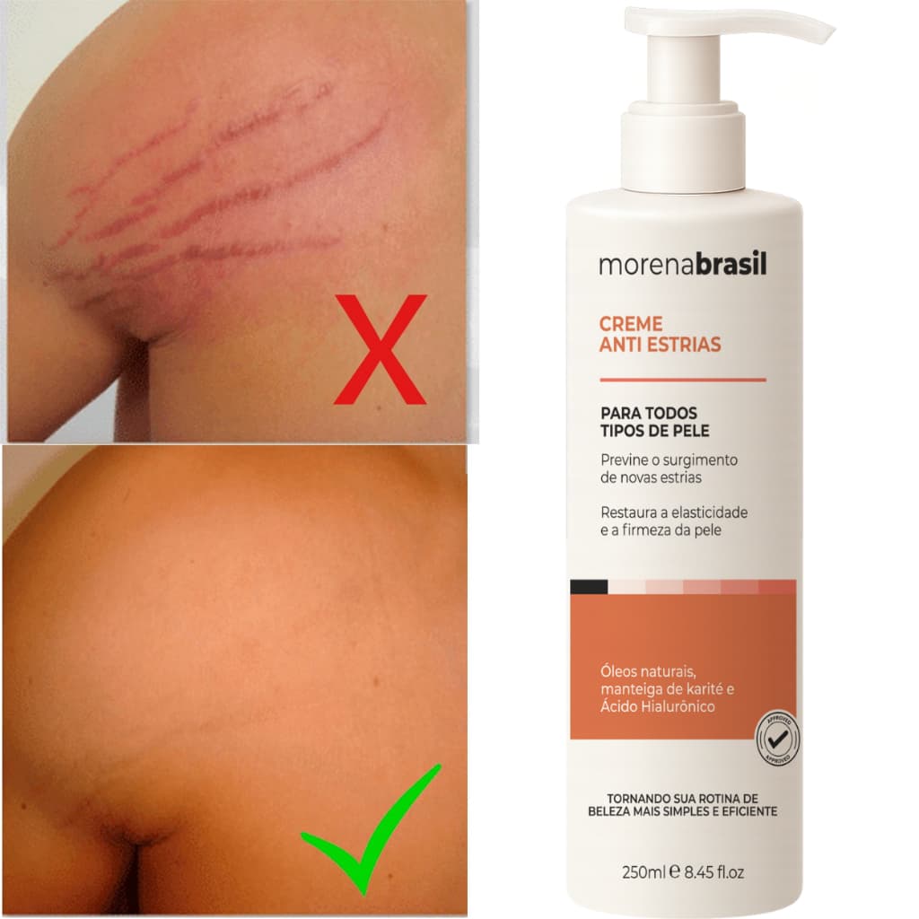 Creme Anti-Estrias Morena Brasil - Ação Poderosa com Colágeno e Elastina