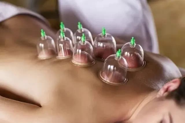 Kit 12 Ventosas Com Bomba Ventosaterapia Massoterapia Chines — imagem 5